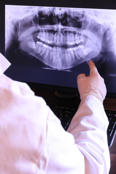 Best Emergency Wisdom Teeth Removal in Cumberland Hill, RI